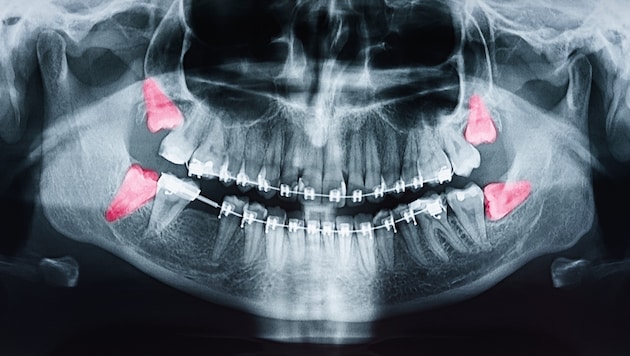 So sehen die Weisheitszähne (in rot) am Röntgenbild aus. (Bild: stock.adobe.com/RADU BERCAN)