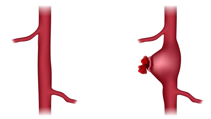 Reißt die Hauptschlagader, etwa durch eine Aussackung (Aneurysma), besteht Lebensgefahr.