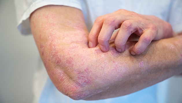 Zuletzt am häufigsten wurden die Hashimoto-Thyreoiditis, gefolgt von der Psoriasis (Bild) und der rheumatoiden Arthritis. (Bild: Daniel Beckemeier, stock.adobe.com)