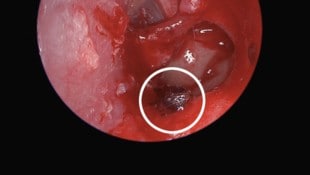 Die lebende Ameise (weiß markiert) war durch ein Loch im Trommelfell ins Mittelohr der Patientin gekrochen. (Bild: Diagnostics/Peter Kiss et al., Krone KREATIV)