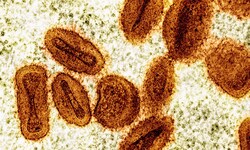 Die kolorierte elektronenmikroskopische Aufnahme zeigt Mpox-Viruspartikel (bräunlich), die sich ...