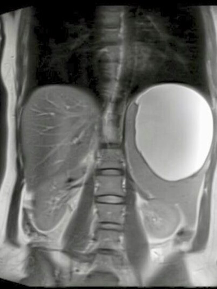 The white spot on the right shows the huge cyst on the X-ray image