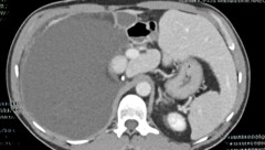 Das Ärzteteam entfernte einen gewaltigen Tumor (im Bild der große, dunkelgraue Bereich links). (Bild: zVg)