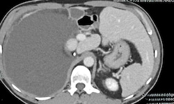 Das Ärzteteam entfernte einen gewaltigen Tumor (im Bild der große, dunkelgraue Bereich links).