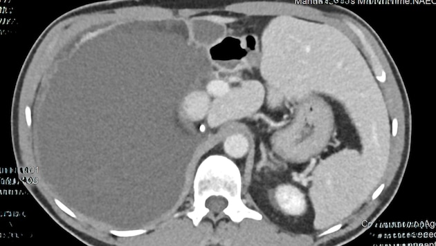 The medical team removed a huge tumor (the large, dark grey area on the left in the picture). (Bild: zVg)