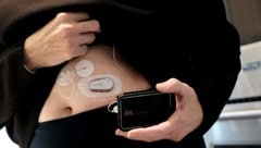 Eine Typ-1-Diabetes-Patientin mit einer Insulinpumpe (Bild: APA/Getty Images via AFP/GETTY IMAGES/SPENCER PLATT)