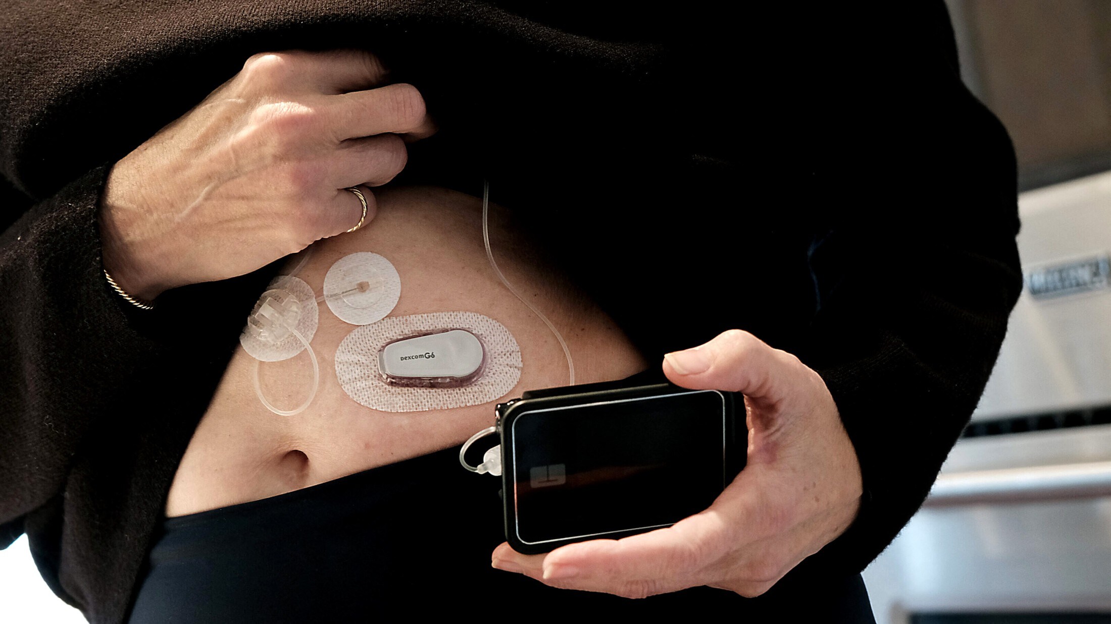 Transplantationserfolg - Hoffnung auf Heilung von Typ-1-Diabetes steigt