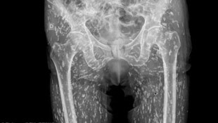 Dieses Röntgenbild schockt sogar die Mediziner.