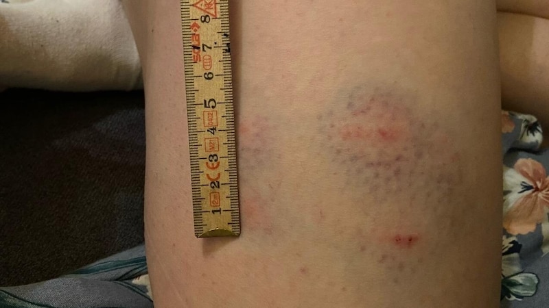 The bite wound on the Mühlviertel woman's thigh (Bild: Astrid Hinterreiter)