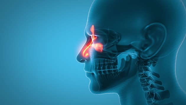 Bei Sinusitis sind Schleimhäute des Riechorgans und der Nebenhöhlen überwiegend gleichzeitig betroffen. (Bild: labden/stock.adobe.com)