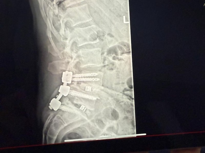 Michael Konsel's X-ray after the successful lumbar spine operation in Innsbruck. (Bild: Privat)