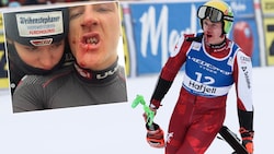 Die Freundin von Raphael Haaser, Fabiana Dorigo, postete ein Foto von den blutigen Zähnen ihres ...