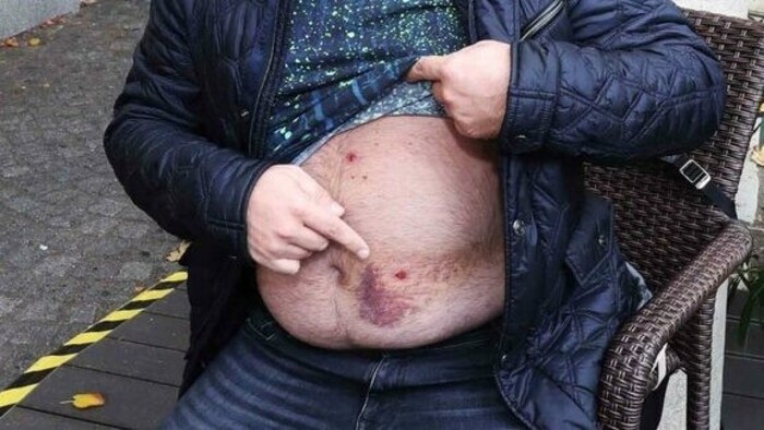 Patrick S. zeigte der „Krone“ im Oktober 2023 die damals frischen Wunden.