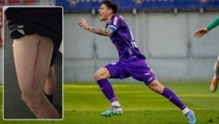 Eine heftige Narbe ziert Toshevskis Oberschenkel. (Bild: Claudio Trevisan, GEPA)