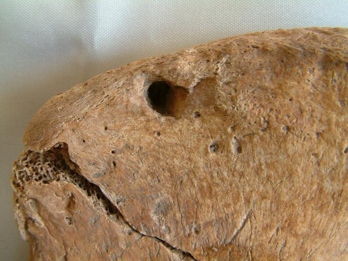 Der Beckenknochen eines römischen Gladiators, der Bissspuren (Löcher) einer Raubkatze zeigt