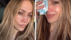 Jennifer Lopez nach dem Unfall – mit Eisbeutel auf der Nase. Die Verletzung musste genäht werden. (Bild: Krone KREATIV/www.instagram.com/jlo/)