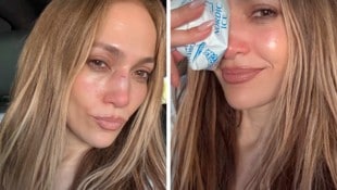 Jennifer Lopez nach dem Unfall – mit Eisbeutel auf der Nase. Die Verletzung musste genäht ...