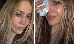 Jennifer Lopez nach dem Unfall – mit Eisbeutel auf der Nase. Die Verletzung musste genäht ...