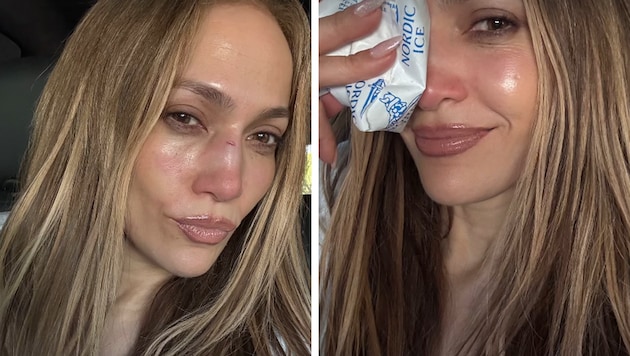 Jennifer Lopez nach dem Unfall – mit Eisbeutel auf der Nase. Die Verletzung musste genäht ...