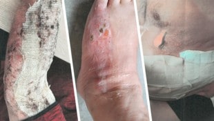 Der Tiroler erlitt Verbrühungen an mehreren Körperstellen. (Bild: Krone KREATIV/Privat)
