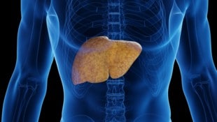 Die Hauptursachen einer Fettleber sind Übergewicht, ungesunde Ernährung mit viel Zucker und ungesunden Fetten sowie Bewegungsmangel. (Bild: stock.adobe.com null)