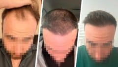 „Krone“-Leser Daniel S. zieht nach einer Haartransplantation in der Türkei Bilanz.