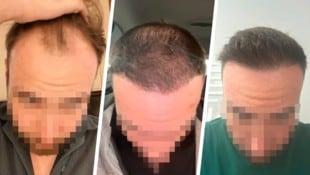 „Krone“-Leser Daniel S. zieht nach einer Haartransplantation in der Türkei Bilanz. (Bild: Krone KREATIV/Daniel S.)