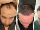 „Krone“-Leser Daniel S. zieht nach einer Haartransplantation in der Türkei Bilanz. (Bild: Krone KREATIV/Daniel S.)
