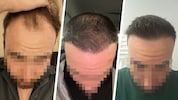 „Krone“-Leser Daniel S. zieht nach einer Haartransplantation in der Türkei Bilanz.