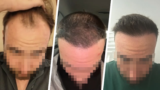 „Krone“-Leser Daniel S. zieht nach einer Haartransplantation in der Türkei Bilanz.