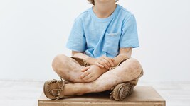 Hinter weißen Flecken auf der Haut muss nicht immer Vitiligo stecken.