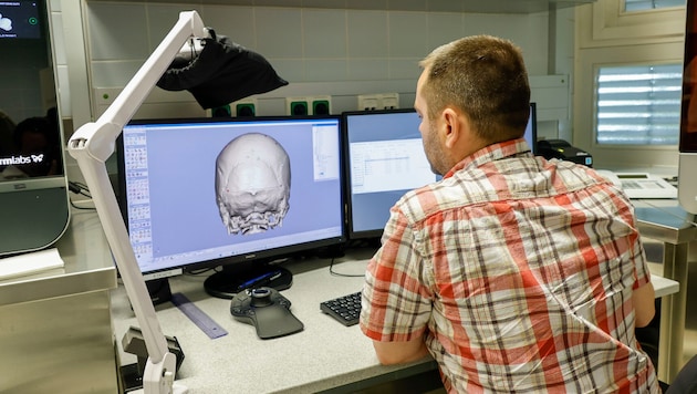 Bei diesem Patienten muss ein Defekt am Hinterhaupt repariert werden: In einer eigenen Software wird das Implantat am PC modelliert.
