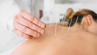 Die Akupunktur ist die bekannteste Behandlungsmethode in der Traditionellen Chinesischen Medizin ...