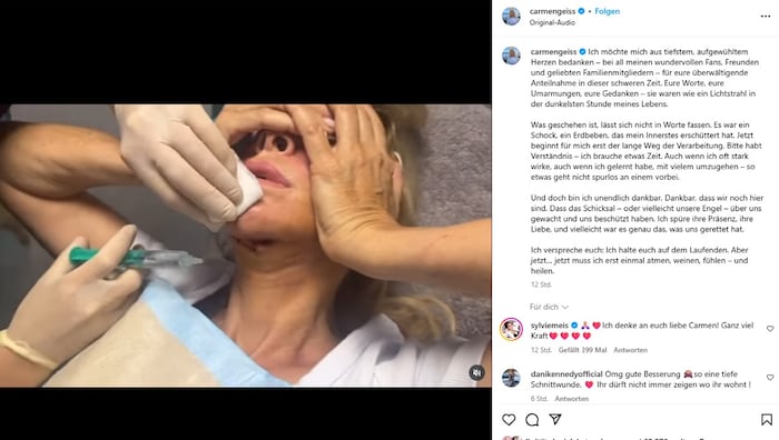 Auf Instagram zeigte Carmen Geiss ein Video, in dem die ihre Schnittwunde am Hals zu sehen ist.