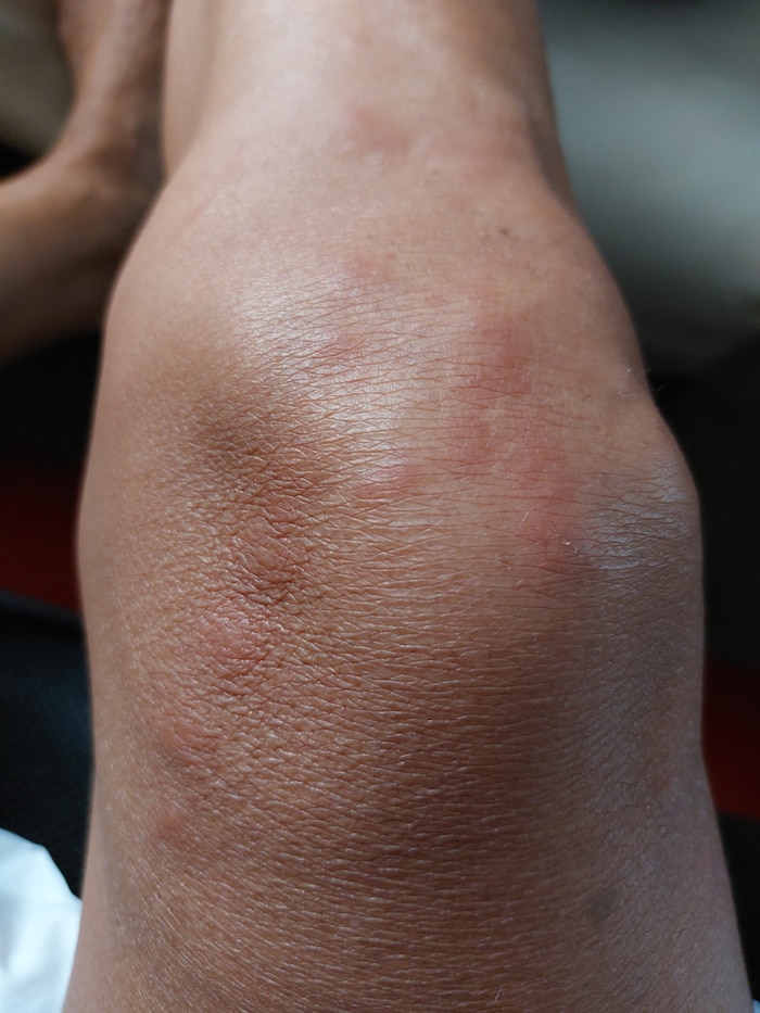 Zahlreiche Bisse wurden nach wenigen Stunden am Knie sichtbar.