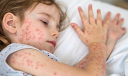 Fieber, die Haut mit roten Pusteln überzogen: Das Masernvirus ist hoch ansteckend. 