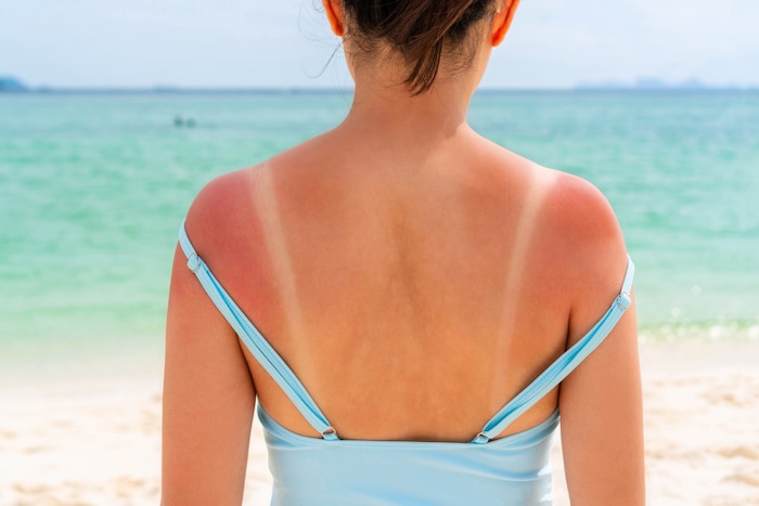 Die Haut merkt sich jeden Sonnenbrand. Die typischen Symptome sind Zeichen der Zellschäden.