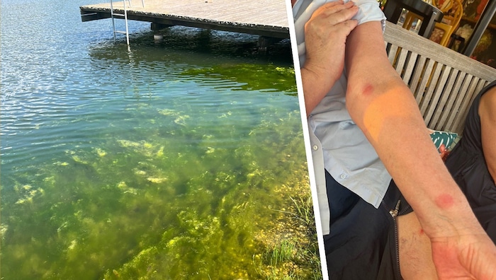 Algenbildung und Zerkarien: Ein Besuch am Stausee bescherte Gästen Juckreiz und Pusteln.