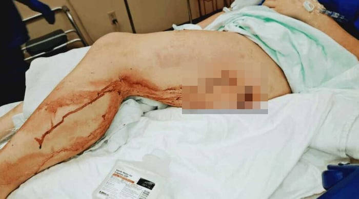 Mit blutenden Wunden wurde Summer in die Notaufnahme eines Krankenhauses geflogen.