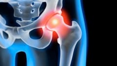 Arthrose führt mit der Zeit meist zu Schmerzen und Bewegungseinschränkungen.