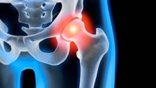 Arthrose führt mit der Zeit meist zu Schmerzen und Bewegungseinschränkungen.