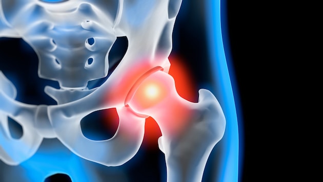 Arthrose führt mit der Zeit meist zu Schmerzen und Bewegungseinschränkungen.