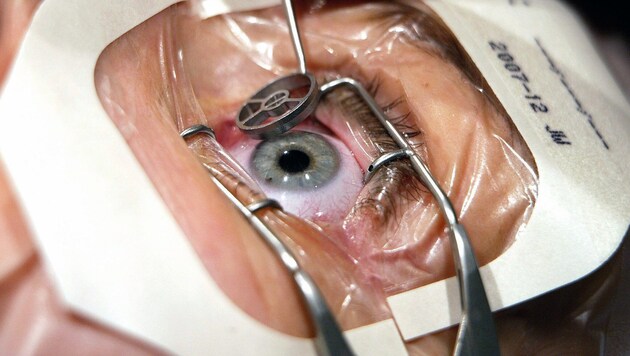 Etwa 10.000 Grauer-Star-Operationen werden pro Jahr in der Steiermark durchgeführt.
