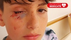 Kurz nach Sebastians Unfall sah sein Gesicht so aus.
