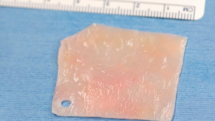 Hergestelltes Knorpelimplantat – Auf einer Kollagenmembran gezüchtete Knorpelzellen aus der ...