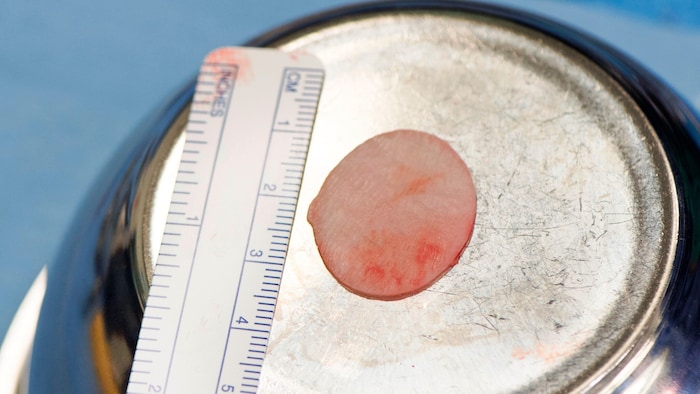 Exakt auf den Knorpeldefekt zugeschnitten und bereit für die Implantation ins Knie.