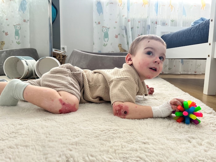 Halid (2) aus Leoben leidet an der schwersten Form der seltenen Schmetterlingskrankheit.