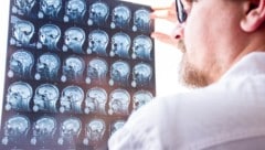 Bessere Diagnosekriterien bei  Multipler Sklerose.