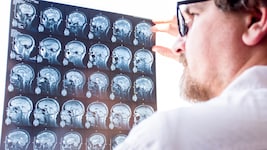 Bessere Diagnosekriterien bei  Multipler Sklerose.