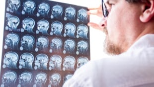 Bessere Diagnosekriterien bei  Multipler Sklerose.